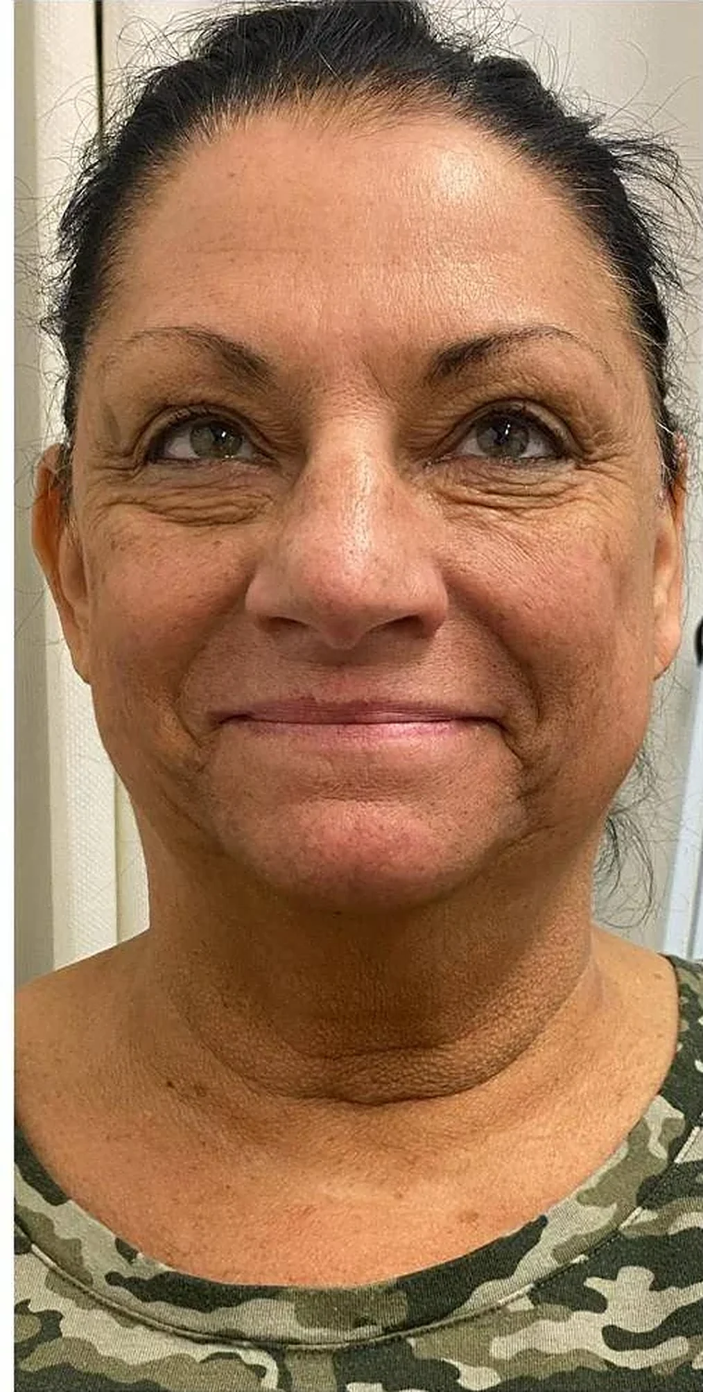 Before — Jawline & neck