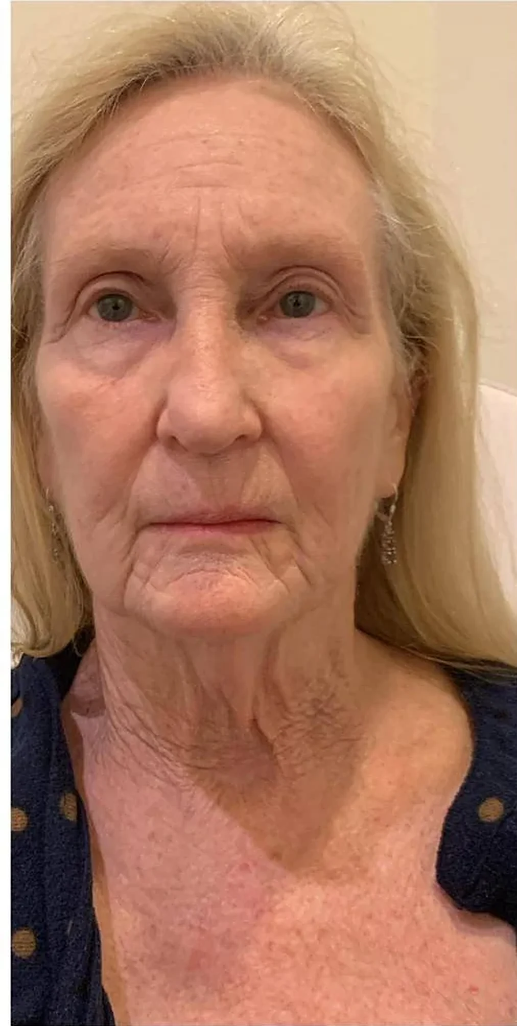Before — Firmness & laxity
